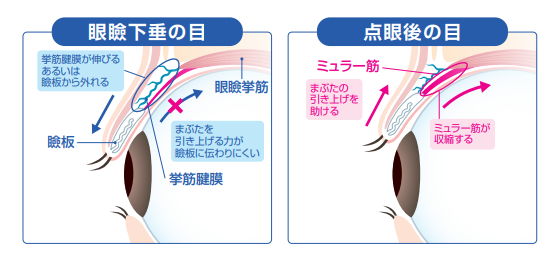 アップニークミニのはたらき：眼瞼下垂の目と点眼後の目の比較図