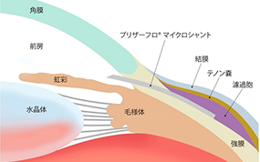 プリザーフロマイクロシャントスライド8