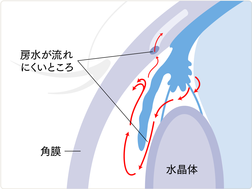 開放隅角緑内障・正常眼圧緑内障