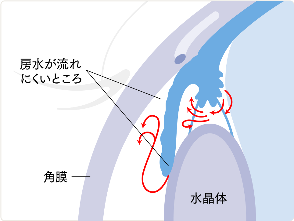 閉塞隅角緑内障